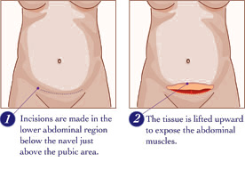 Tummy Tuck Procedure: What Are The Different Types? - Dr. Markarian