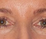 Blepharoplasty Before & After Patient #684