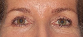 Blepharoplasty Before & After Patient #684