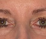 Blepharoplasty Before & After Patient #684