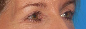 Blepharoplasty Before & After Patient #684