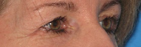Blepharoplasty Before & After Patient #684