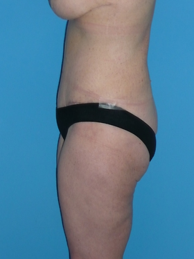 Tummy Tuck Before & After Patient #662