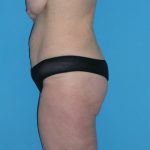 Tummy Tuck Before & After Patient #662