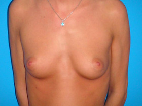 Breast Augmentation Before & After Patient #747