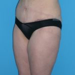 Tummy Tuck Before & After Patient #662