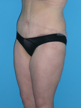 Tummy Tuck Before & After Patient #662