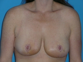 Tummy Tuck Before & After Patient #662