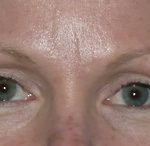 Blepharoplasty Before & After Patient #704