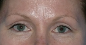 Blepharoplasty Before & After Patient #704