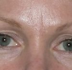 Blepharoplasty Before & After Patient #704