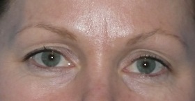 Blepharoplasty Before & After Patient #704