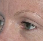 Blepharoplasty Before & After Patient #704