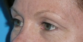 Blepharoplasty Before & After Patient #704