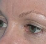 Blepharoplasty Before & After Patient #704
