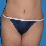 Tummy Tuck Before & After Patient #834