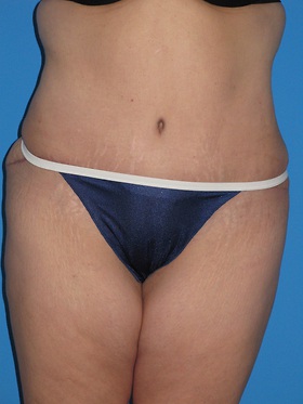 Tummy Tuck Before & After Patient #834