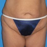 Tummy Tuck Before & After Patient #834