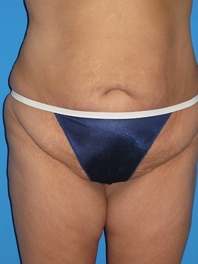 Tummy Tuck Before & After Patient #834