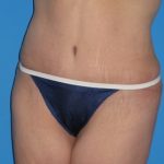 Tummy Tuck Before & After Patient #834