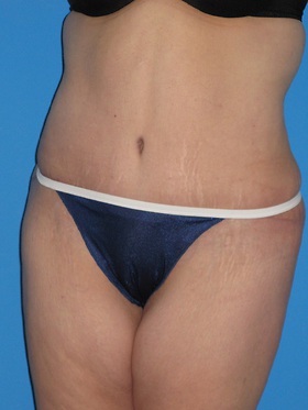 Tummy Tuck Before & After Patient #834