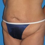 Tummy Tuck Before & After Patient #834