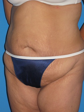 Tummy Tuck Before & After Patient #834