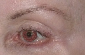 Brow Lift Before & After Patient #709