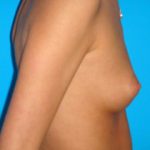 Breast Augmentation Before & After Patient #747