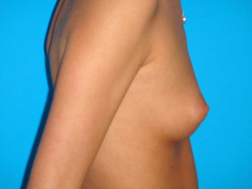 Breast Augmentation Before & After Patient #747