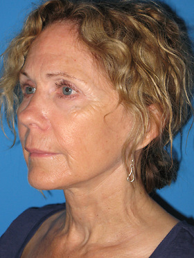 Facelift Before & After Patient #731