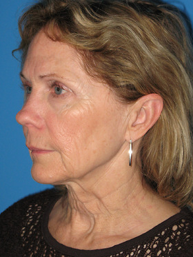 Facelift Before & After Patient #731