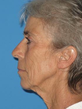 Facelift Before & After Patient #736