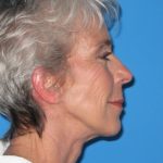 Facelift Before & After Patient #736