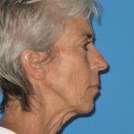 Facelift Before & After Patient #736