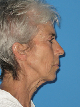 Facelift Before & After Patient #736