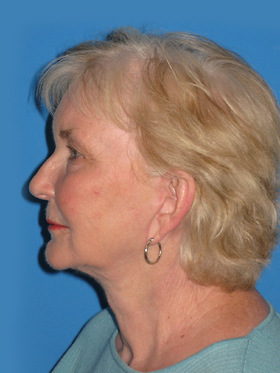 Facelift Before & After Patient #719