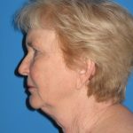 Facelift Before & After Patient #719