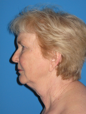 Facelift Before & After Patient #719