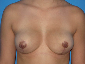 Breast Reduction Before & After Patient #810