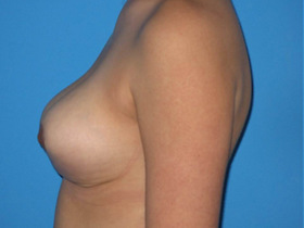 Breast Reduction Before & After Patient #810