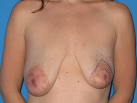 Breast Augmentation Before & After Patient #787