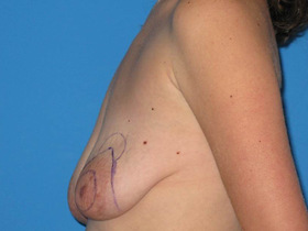 Breast Augmentation Before & After Patient #787