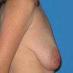 Breast Augmentation Before & After Patient #787