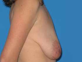 Breast Augmentation Before & After Patient #787