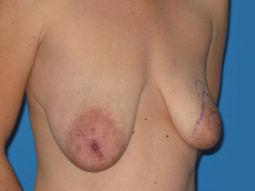 Breast Augmentation Before & After Patient #787