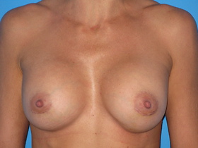 Breast Augmentation Before & After Patient #769