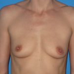 Breast Augmentation Before & After Patient #769