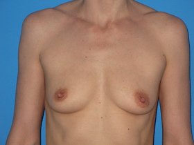 Breast Augmentation Before & After Patient #769