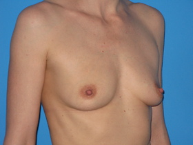 Breast Augmentation Before & After Patient #769